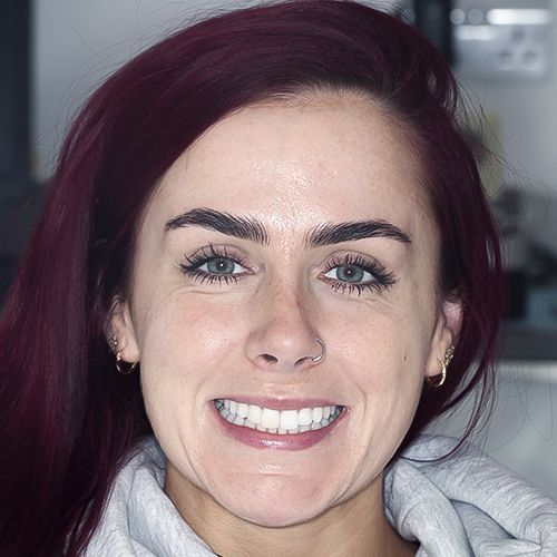 Sarah - composite bonding - before - 3dental